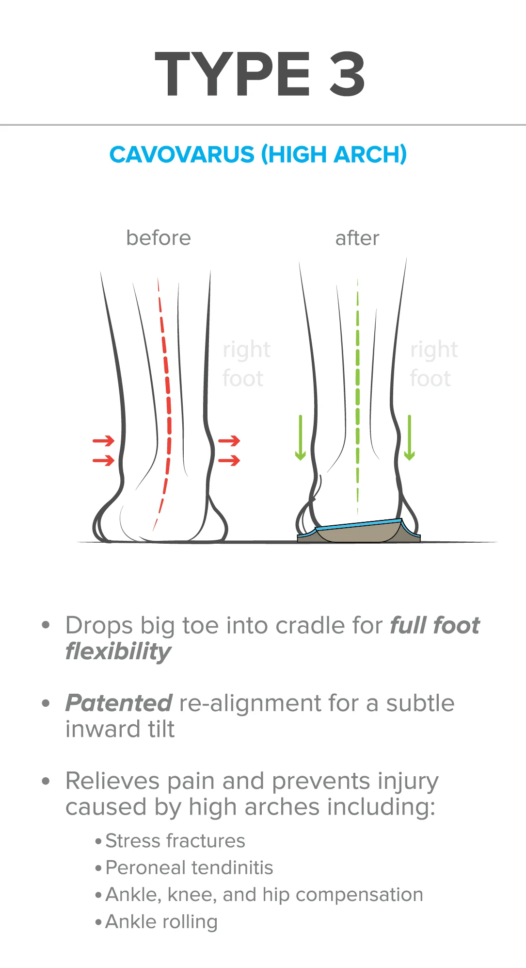FootScientific Arches Specialty Orthotics - ARC-0017